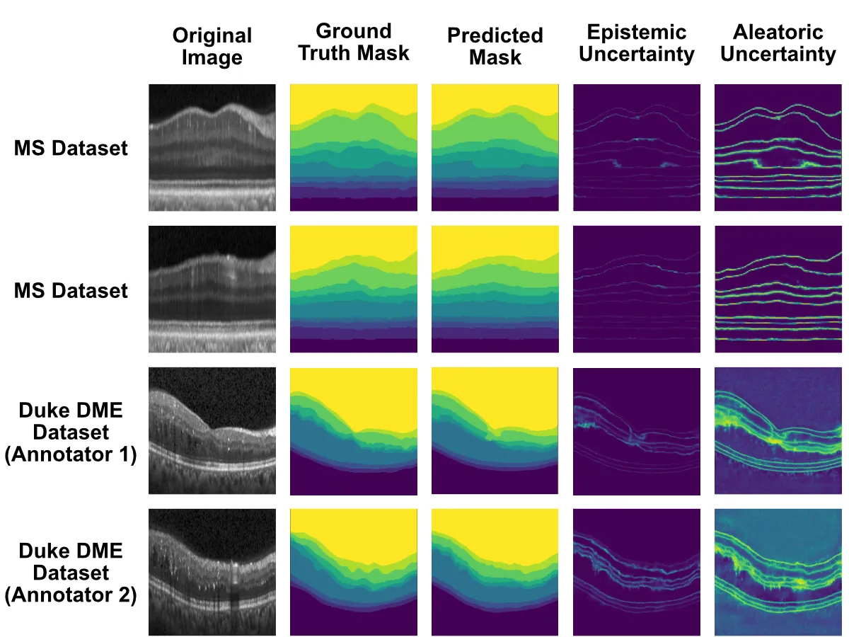 OCT scans from the multiple-sclerosis and diabetic-macular-oedema datasets with ground-truth and predicted retinal-layer masks, plus epistemic and aleatoric uncertainty maps.